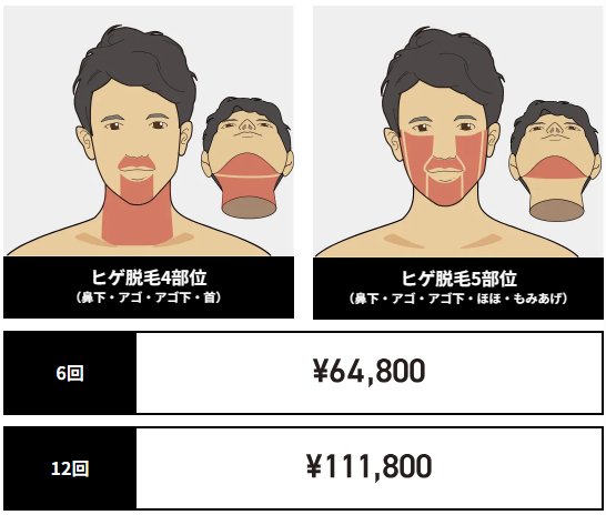 【必見】ゴリラクリニックでヒゲ脱毛、何回くらいで効果を実感できる？